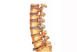 Etapas de desenvolvemento da osteocondrose cervical