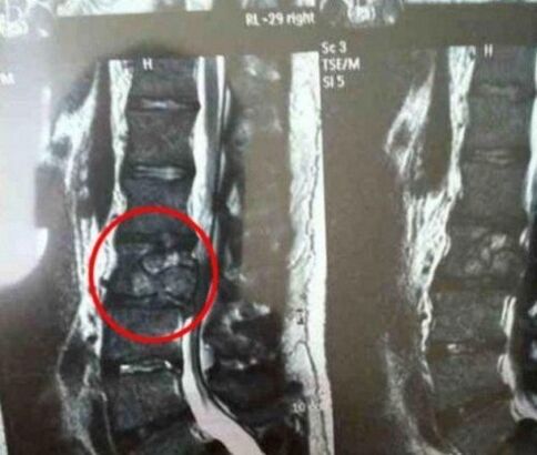 O tumor da columna vertebral na imaxe