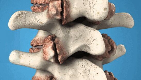 Osteófitos das vértebras - crecementos patolóxicos que danan os nervios e os vasos sanguíneos