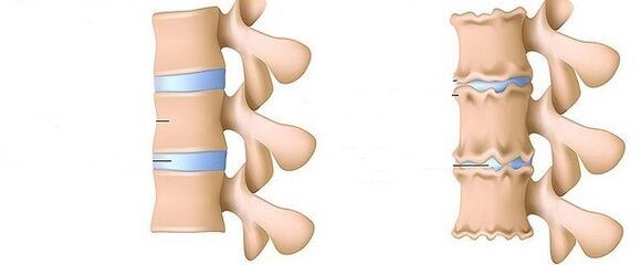 Columna vertebral saudable e osteocondrose