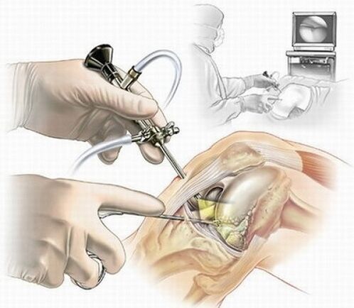 artroscopia de xeonllo para osteoartrite